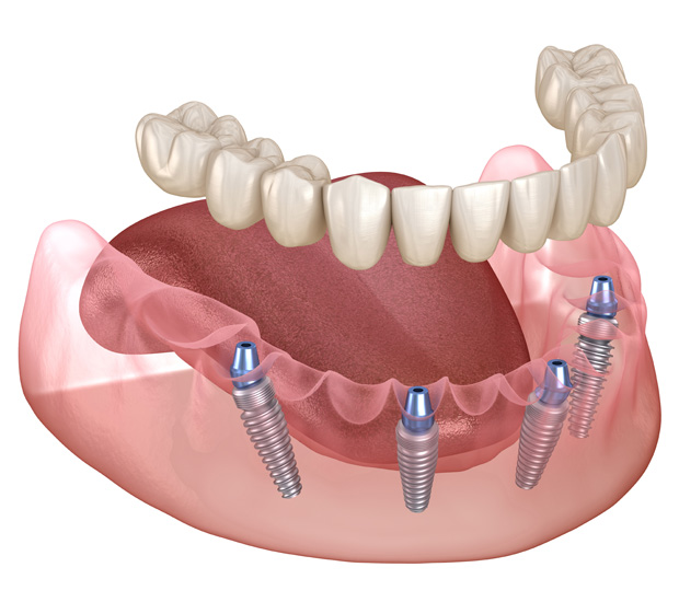 Norwalk All-on-4 Dental Implants