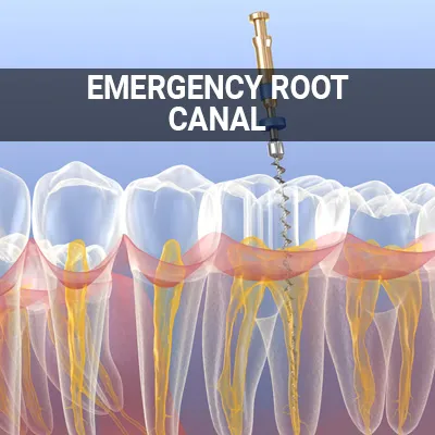 Visit our Emergency Root Canal page