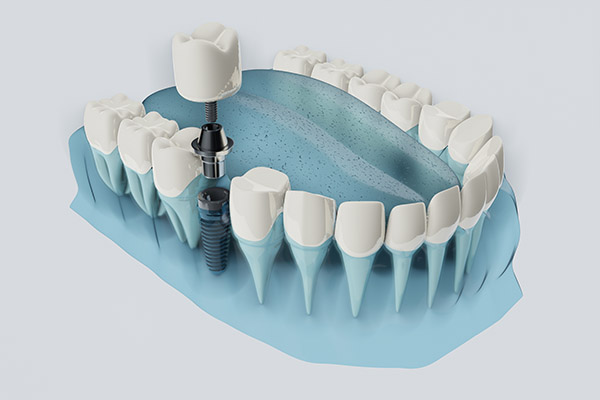 FAQs about Dental Implants from Premier Oral Surgery in Norwalk, CT