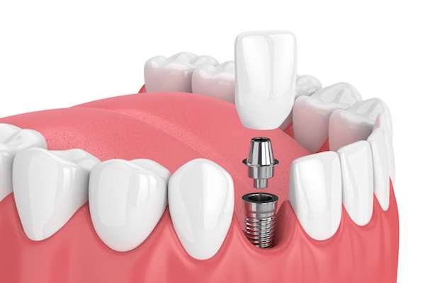 Mini vs. Regular Dental Implants from Premier Oral Surgery in Norwalk, CT