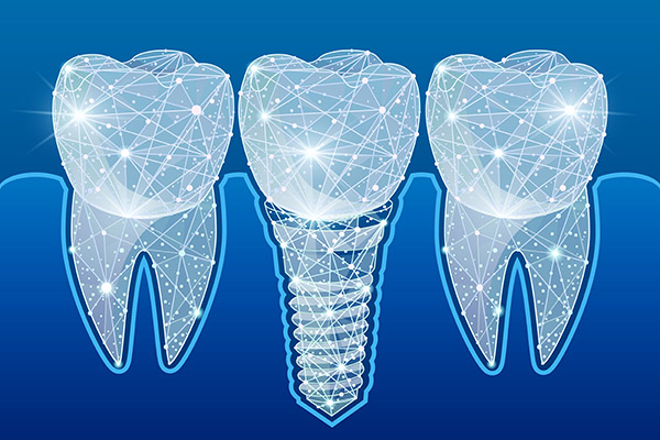 Preventing Complications After Getting Dental Implants from Premier Oral Surgery in Norwalk, CT