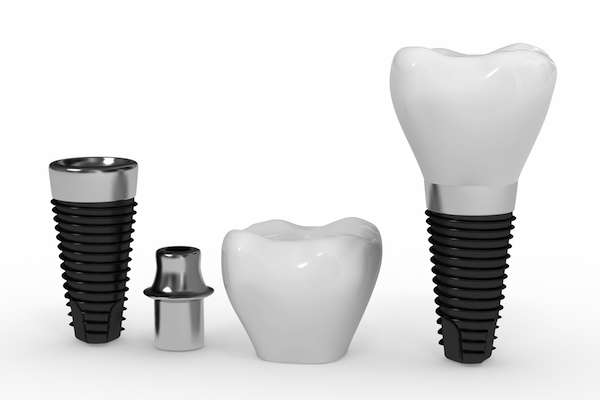 What Are the Parts of Dental Implants from Premier Oral Surgery in Norwalk, CT