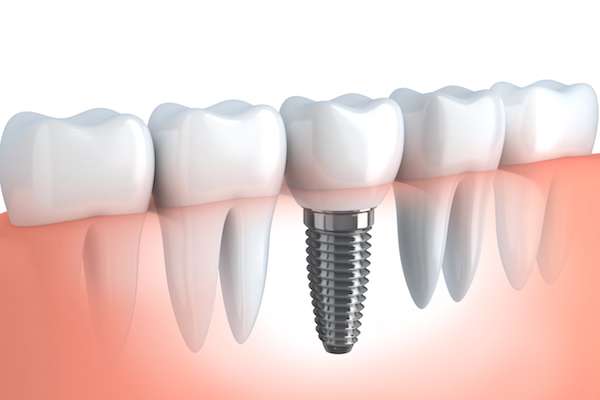 Your Ultimate Guide to Getting Dental Implants from Premier Oral Surgery in Norwalk, CT